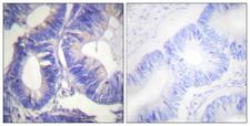 GRB4 / NCK2 Antibody - Immunohistochemistry analysis of paraffin-embedded human colon carcinoma tissue, using NCK2 Antibody. The picture on the right is blocked with the synthesized peptide.