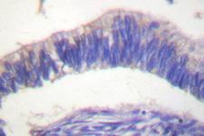 GRB4 / NCK2 Antibody - IHC of NCK2 (I364) pAb in paraffin-embedded human colon carcinoma tissue.
