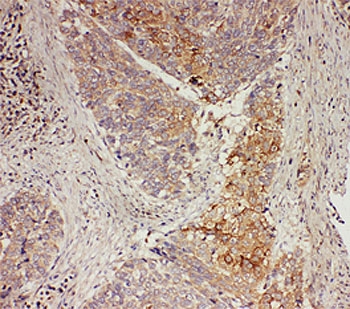 GRB7 Antibody - IHC-P: GRB7 antibody testing of human esophagus squama cancer tissue
