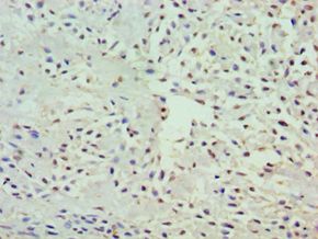 GRB7 Antibody - Immunohistochemistry of paraffin-embedded human breast cancer using antibody at 1:100 dilution.