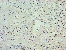 GRB7 Antibody - Immunohistochemistry of paraffin-embedded human breast cancer using antibody at 1:100 dilution.