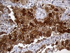 GRB7 Antibody - Immunohistochemical staining of paraffin-embedded Carcinoma of Human lung tissue using anti-GRB7 mouse monoclonal antibody. (Heat-induced epitope retrieval by 1mM EDTA in 10mM Tris buffer. (pH8.5) at 120°C for 3 min. (1:2000)