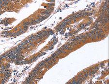 GREB1 Antibody - Immunohistochemistry of paraffin-embedded Human thyroid cancer using GREB1 Polyclonal Antibody at dilution of 1:40.