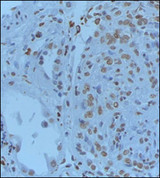 GREM1 / Gremlin-1 Antibody - Formalin-PBS and Bouin embedded paraffin human renal tissue pretreated with heat induced epitope retrieval Citrate buffer pH 6.0 in microwave. Dilution of primary antibody was 1:50. Detection method was ABC system or Vectastaint Elite VECTOR. Data and protocol courtesy of Dr. Maria E. Burgos of Universidad Austral de Chile.