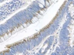 GREM1 / Gremlin-1 Antibody - Detection of CKTSF1B1 in human colon cancer tissue using antibody.