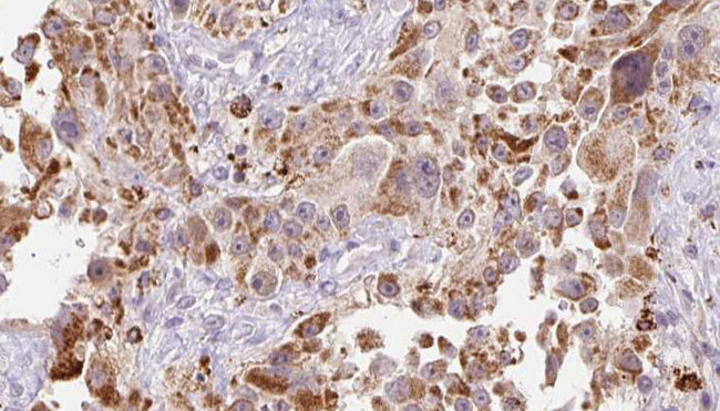 GREM2 / Gremlin 2 Antibody - 1:100 staining human Melanoma tissue by IHC-P. The sample was formaldehyde fixed and a heat mediated antigen retrieval step in citrate buffer was performed. The sample was then blocked and incubated with the antibody for 1.5 hours at 22°C. An HRP conjugated goat anti-rabbit antibody was used as the secondary.