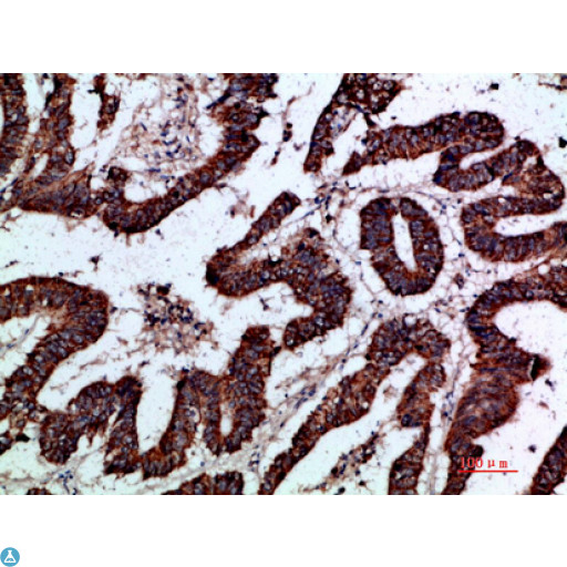GREM2 / Gremlin 2 Antibody - Immunohistochemical analysis of paraffin-embedded human-colon-cancer, antibody was diluted at 1:200.