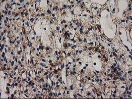 GRHPR / Glyoxylate Reductase Antibody - IHC of paraffin-embedded Carcinoma of Human kidney tissue using anti-GRHPR mouse monoclonal antibody. (Heat-induced epitope retrieval by 10mM citric buffer, pH6.0, 100C for 10min).