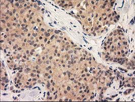 GRHPR / Glyoxylate Reductase Antibody - IHC of paraffin-embedded Adenocarcinoma of Human breast tissue using anti-GRHPR mouse monoclonal antibody.