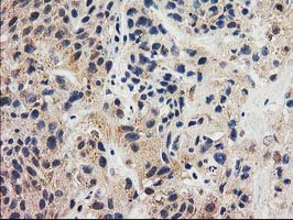 GRHPR / Glyoxylate Reductase Antibody - IHC of paraffin-embedded Carcinoma of Human bladder tissue using anti-GRHPR mouse monoclonal antibody. (Heat-induced epitope retrieval by 10mM citric buffer, pH6.0, 100C for 10min).