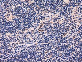 GRHPR / Glyoxylate Reductase Antibody - IHC of paraffin-embedded Human lymphoma tissue using anti-GRHPR mouse monoclonal antibody. (Heat-induced epitope retrieval by 10mM citric buffer, pH6.0, 100C for 10min).