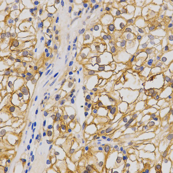 GRIA1 / GLUR1 Antibody - Immunohistochemistry of paraffin-embedded human stomach cancer using GRIA1 antibody at dilution of 1:200 (x400 lens)