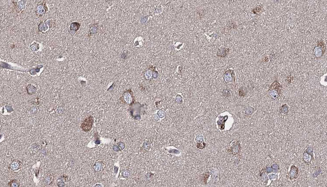 GRIA1 / GLUR1 Antibody - 1:100 staining human brain carcinoma tissue by IHC-P. The sample was formaldehyde fixed and a heat mediated antigen retrieval step in citrate buffer was performed. The sample was then blocked and incubated with the antibody for 1.5 hours at 22°C. An HRP conjugated goat anti-rabbit antibody was used as the secondary.