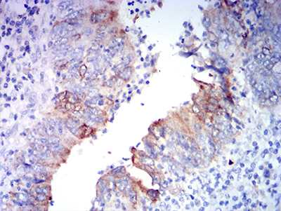 GRIA2 / GLUR2 Antibody - Immunohistochemical analysis of paraffin-embedded rectum cancer tissues using GRIA2 mouse mAb with DAB staining.