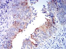 GRIA2 / GLUR2 Antibody - Immunohistochemical analysis of paraffin-embedded rectum cancer tissues using GRIA2 mouse mAb with DAB staining.