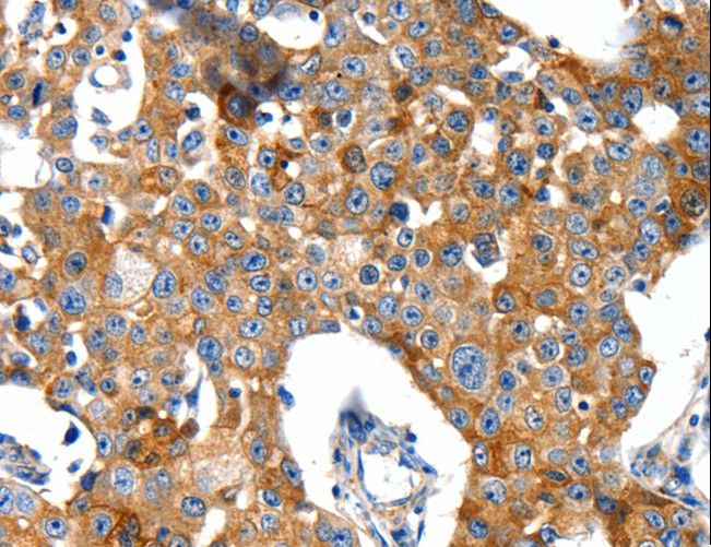 GRIA2 / GLUR2 Antibody - Immunohistochemistry of paraffin-embedded Human gastric cancer using GRIA2 Polyclonal Antibody at dilution of 1:40.