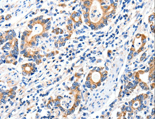 GRIA2 / GLUR2 Antibody - Immunohistochemistry of paraffin-embedded Human gastric cancer using GRIA2 Polyclonal Antibody at dilution of 1:40.