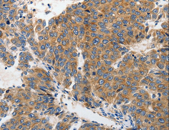 GRIA2 / GLUR2 Antibody - Immunohistochemistry of paraffin-embedded Human colon cancer using GRIA2 Polyclonal Antibody at dilution of 1:70.