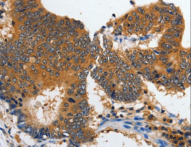 GRIA2 / GLUR2 Antibody - Immunohistochemistry of paraffin-embedded Human colon cancer using GRIA2 Polyclonal Antibody at dilution of 1:70.