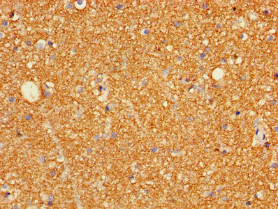 GRIA3 / GLUR3 Antibody - Immunohistochemistry of paraffin-embedded human gastric cancer using GRIA3 Antibody at dilution of 1:100