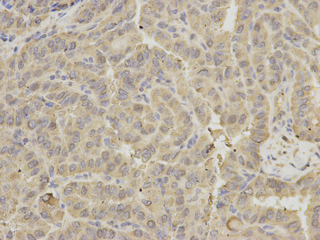GRIA3 / GLUR3 Antibody - Immunohistochemistry of paraffin-embedded human thyroid cancer using GRIA3 antibody at dilution of 1:200 (400x lens).