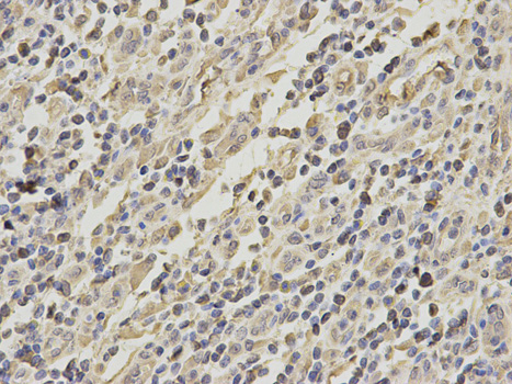 GRIA3 / GLUR3 Antibody - Immunohistochemistry of paraffin-embedded human stomach cancer using GRIA3 antibody at dilution of 1:200 (400x lens).