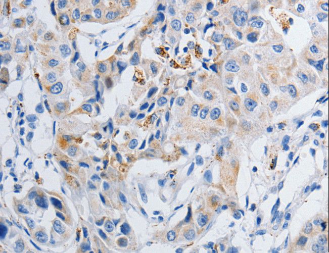 GRIA3 / GLUR3 Antibody - Immunohistochemistry of paraffin-embedded Human lung cancer using GRIA3 Polyclonal Antibody at dilution of 1:50.