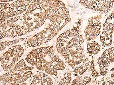 GRIA4 / GLUR4 Antibody - Immunohistochemistry of paraffin-embedded Human esophagus cancer tissue  using GRIA4 Polyclonal Antibody at dilution of 1:40(×200)
