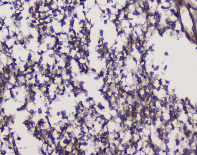 GRIK1 / GLUR5 Antibody - IHC analysis of GRIK1 using anti-GRIK1 antibody. GRIK1 was detected in paraffin-embedded section of human glioma tissues. Heat mediated antigen retrieval was performed in citrate buffer (pH6, epitope retrieval solution) for 20 mins. The tissue section was blocked with 10% goat serum. The tissue section was then incubated with 1µg/ml rabbit anti-GRIK1 Antibody overnight at 4°C. Biotinylated goat anti-rabbit IgG was used as secondary antibody and incubated for 30 minutes at 37°C. The tissue section was developed using Strepavidin-Biotin-Complex (SABC) with DAB as the chromogen.