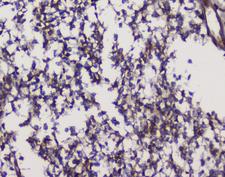GRIK1 / GLUR5 Antibody - IHC analysis of GRIK1 using anti-GRIK1 antibody. GRIK1 was detected in paraffin-embedded section of human glioma tissues. Heat mediated antigen retrieval was performed in citrate buffer (pH6, epitope retrieval solution) for 20 mins. The tissue section was blocked with 10% goat serum. The tissue section was then incubated with 1µg/ml rabbit anti-GRIK1 Antibody overnight at 4°C. Biotinylated goat anti-rabbit IgG was used as secondary antibody and incubated for 30 minutes at 37°C. The tissue section was developed using Strepavidin-Biotin-Complex (SABC) with DAB as the chromogen.