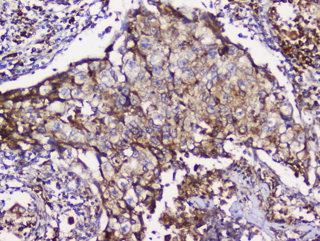 GRIK1 / GLUR5 Antibody - IHC analysis of GRIK1 using anti-GRIK1 antibody. GRIK1 was detected in paraffin-embedded section of human Lung cancer tissues. Heat mediated antigen retrieval was performed in citrate buffer (pH6, epitope retrieval solution) for 20 mins. The tissue section was blocked with 10% goat serum. The tissue section was then incubated with 1µg/ml rabbit anti-GRIK1 Antibody overnight at 4°C. Biotinylated goat anti-rabbit IgG was used as secondary antibody and incubated for 30 minutes at 37°C. The tissue section was developed using Strepavidin-Biotin-Complex (SABC) with DAB as the chromogen.