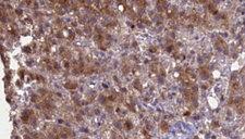 GRIK2 / GLUR6 Antibody - 1:100 staining human liver carcinoma tissues by IHC-P. The sample was formaldehyde fixed and a heat mediated antigen retrieval step in citrate buffer was performed. The sample was then blocked and incubated with the antibody for 1.5 hours at 22°C. An HRP conjugated goat anti-rabbit antibody was used as the secondary.