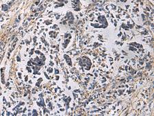 GRIK2 / GLUR6 Antibody - Immunohistochemistry of paraffin-embedded Human breast cancer tissue  using GRIK2 Polyclonal Antibody at dilution of 1:60(×200)