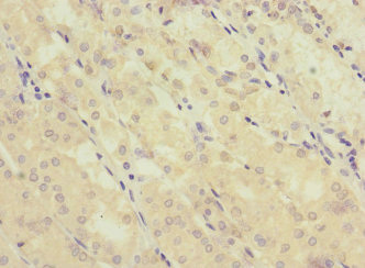 GRIK3 / GLUR7 Antibody - Immunohistochemistry of paraffin-embedded human gastric cancer at dilution 1:100
