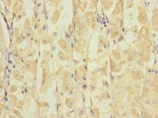 GRIK3 / GLUR7 Antibody - Immunohistochemistry of paraffin-embedded human gastric cancer at dilution 1:100