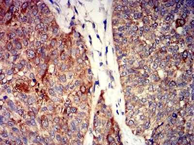 GRIK4 / KA1 Antibody - Immunohistochemical analysis of paraffin-embedded bladder cancer tissues using GRIK4 mouse mAb with DAB staining.