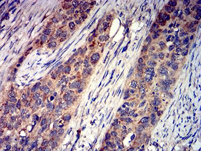 GRIK4 / KA1 Antibody - Immunohistochemical analysis of paraffin-embedded cervical cancer tissues using GRIK4 mouse mAb with DAB staining.