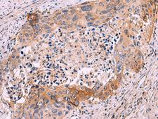 GRIK4 / KA1 Antibody - Immunohistochemistry of paraffin-embedded Human cervical cancer tissue  using GRIK4 Polyclonal Antibody at dilution of 1:50(×200)