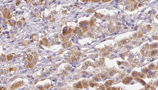 GRIK5 / KA2 Antibody - 1:100 staining human liver carcinoma tissues by IHC-P. The sample was formaldehyde fixed and a heat mediated antigen retrieval step in citrate buffer was performed. The sample was then blocked and incubated with the antibody for 1.5 hours at 22°C. An HRP conjugated goat anti-rabbit antibody was used as the secondary.