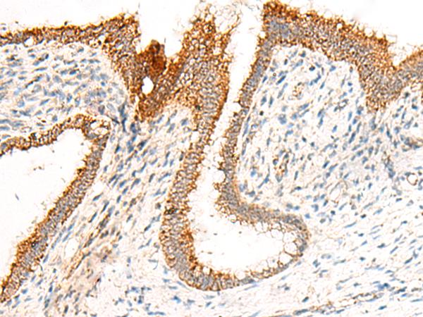 GRIK5 / KA2 Antibody - Immunohistochemistry of paraffin-embedded Human cervical cancer tissue  using GRIK5 Polyclonal Antibody at dilution of 1:35(×200)