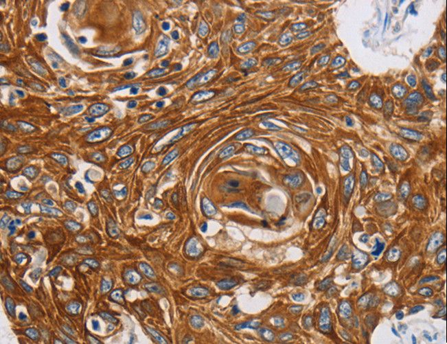 GRIN1 / NMDAR1 Antibody - Immunohistochemistry of paraffin-embedded Human liver cancer using GRIN1 Polyclonal Antibody at dilution of 1:45.
