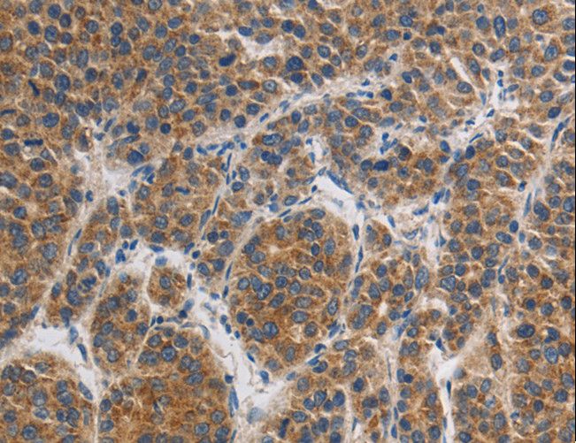 GRIN1 / NMDAR1 Antibody - Immunohistochemistry of paraffin-embedded Human liver cancer using GRIN1 Polyclonal Antibody at dilution of 1:45.