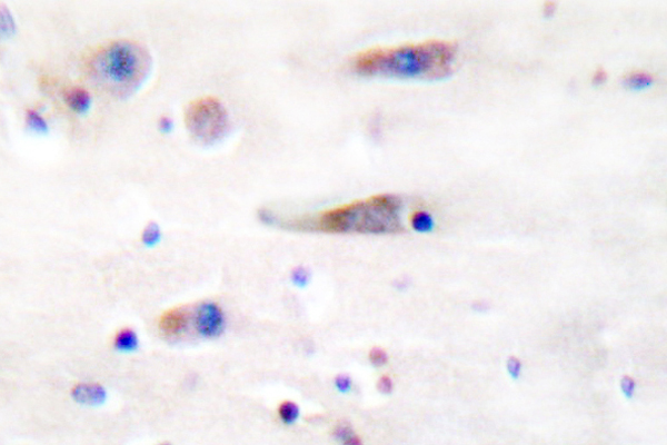 GRIN1 / NMDAR1 Antibody - IHC of NMDA1 (F891) pAb in paraffin-embedded human breast carcinoma tissue.