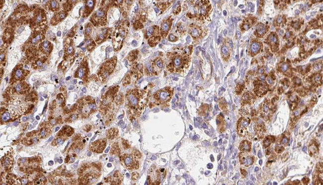 GRIN2A / NMDAR2A / NR2A Antibody - 1:100 staining human liver carcinoma tissues by IHC-P. The sample was formaldehyde fixed and a heat mediated antigen retrieval step in citrate buffer was performed. The sample was then blocked and incubated with the antibody for 1.5 hours at 22°C. An HRP conjugated goat anti-rabbit antibody was used as the secondary.