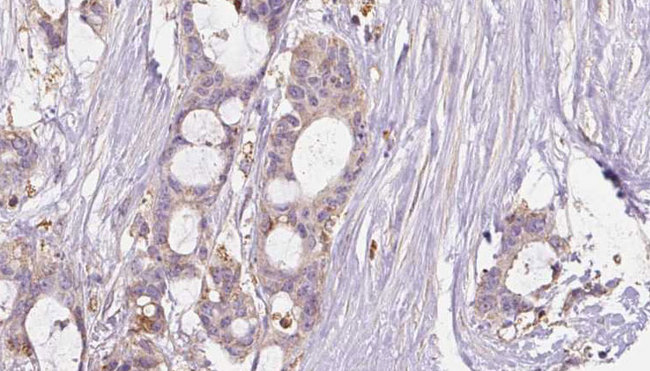GRIN2B / NMDAR2B / NR2B Antibody - 1:100 staining human liver carcinoma tissues by IHC-P. The sample was formaldehyde fixed and a heat mediated antigen retrieval step in citrate buffer was performed. The sample was then blocked and incubated with the antibody for 1.5 hours at 22°C. An HRP conjugated goat anti-rabbit antibody was used as the secondary.