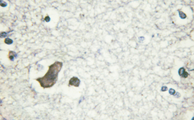 GRIN2B / NMDAR2B / NR2B Antibody - 1/100 staining human brain tissue by IHC-P. The sample was formaldehyde fixed and a heat mediated antigen retrieval step in citrate buffer was performed. The sample was then blocked and incubated with the antibody for 1.5 hours at 22°C. An HRP conjugated goat anti-rabbit antibody was used as the secondary antibody.