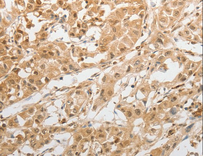 GRIN2C / NMDAR2C / NR2C Antibody - Immunohistochemistry of paraffin-embedded Human lung cancer using GRIN2C Polyclonal Antibody at dilution of 1:100.