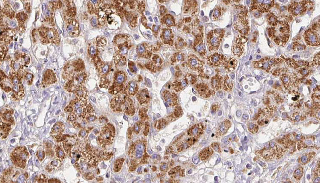 GRIN2C / NMDAR2C / NR2C Antibody - 1:100 staining human liver carcinoma tissues by IHC-P. The sample was formaldehyde fixed and a heat mediated antigen retrieval step in citrate buffer was performed. The sample was then blocked and incubated with the antibody for 1.5 hours at 22°C. An HRP conjugated goat anti-rabbit antibody was used as the secondary.