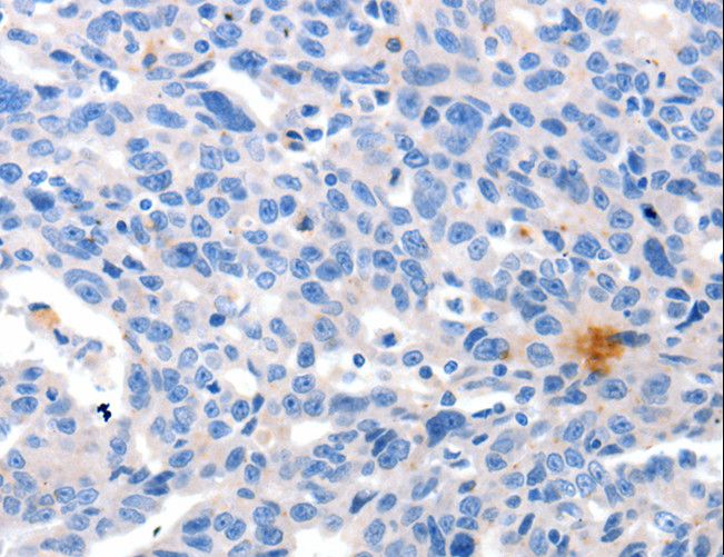 GRIN2D / NMDAR2D / NR2D Antibody - Immunohistochemistry of paraffin-embedded Human ovarian cancer using GRIN2D Polyclonal Antibody at dilution of 1:30.