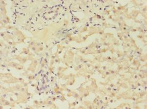 GRK4 Antibody - Immunohistochemistry of paraffin-embedded human liver cancer using antibody at 1: 100 dilution.  This image was taken for the unconjugated form of this product. Other forms have not been tested.